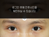 부분절개법 쌍꺼풀수술