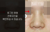 코재수술