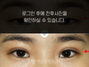 절개법 쌍꺼풀수술