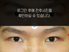 매몰법 쌍꺼풀수술