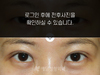 매몰법 쌍꺼풀수술