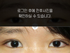 부분절개 쌍꺼풀수술