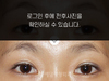 절개법 쌍꺼풀수술
