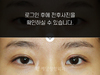 절개법 쌍꺼풀수술