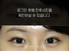 절개법 쌍꺼풀수술