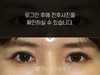매몰법 쌍꺼풀수술
