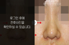 복코성형