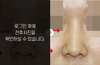 낮은코성형