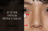 코재수술