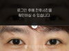 앞트임