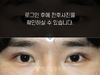 절개법 쌍꺼풀수술