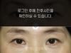 앞트임
