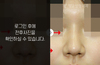 낮은코성형