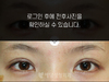 매몰법 쌍꺼풀수술