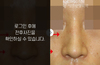 매부리코성형