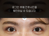 절개법 쌍꺼풀수술+앞트임
