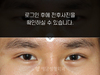 절개법 쌍꺼풀수술