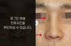 낮은코성형
