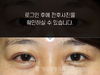 절개법 쌍꺼풀수술