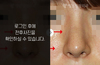 휜코성형