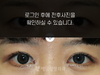 절개법 쌍꺼풀수술+앞트임