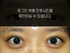 부분절개 쌍꺼풀수술