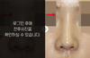낮은코성형
