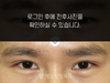 절개법 쌍꺼풀수술