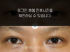 절개법 쌍꺼풀수술+앞트임