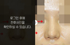 코재수술(보형물 비뚤어짐)