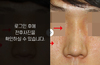 매부리코성형