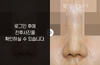 코끝수술(코끝 연골 묶기)