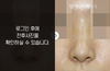 메부리코성형