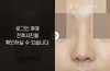 낮은코성형