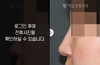 메부리코성형