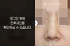 코재수술(돌출현상 교정)