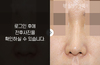 낮은코성형(비중격 연골 휨 발생)