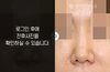 낮은코성형
