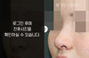 무보형물코성형
