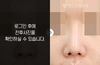 낮은코성형