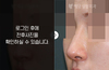 메부리코성형