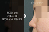 코재수술(비주 흉터 및 실리콘 주변 석회화 개선)