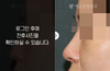 메부리코성형