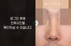 낮은코성형