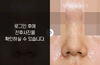 콧볼축소성형